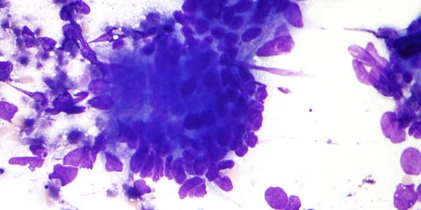 colorectal_adenocarcinoma_cytology_intermed_mag (1)