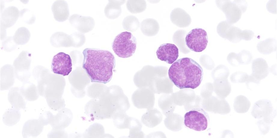 20170329_esteller_leukemia