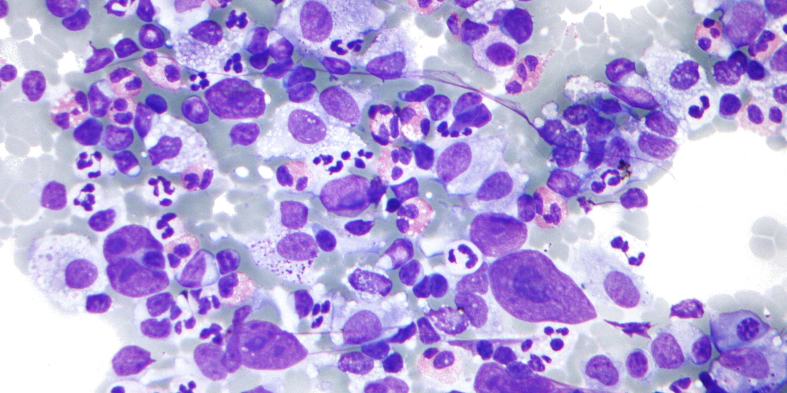 Hodgkin_lymphoma_cytology_large